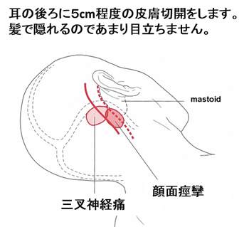 微小血管減圧術
