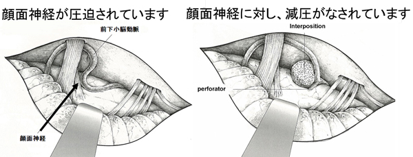 微小血管減圧術