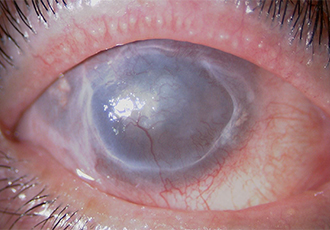 角膜混濁によって失明の状態