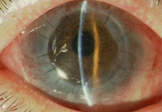術後：自分の口腔粘膜で眼表面を再建したのち角膜移植を行い、視力が回復。自立した生活が可能に