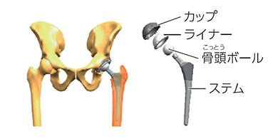 人工股関節全置換術