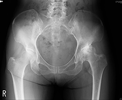 人工股関節全置換術前のレントゲン