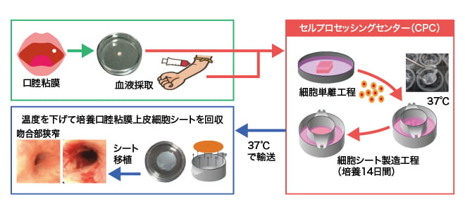 先天性食道閉鎖症吻合部狭窄に対する食道シート移植