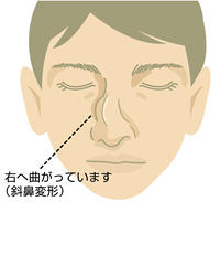 鼻骨骨折による斜鼻変形