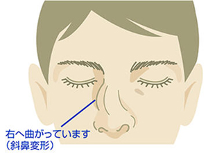 陳旧性鼻骨骨折
