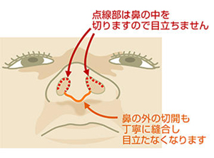陳旧性鼻骨骨折