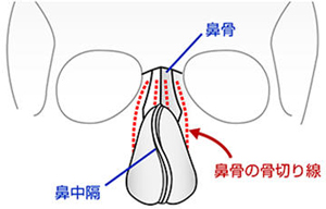 陳旧性鼻骨骨折