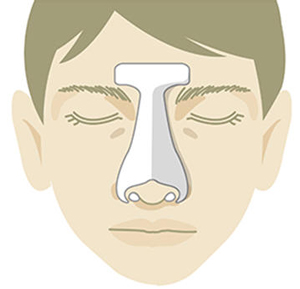 陳旧性鼻骨骨折