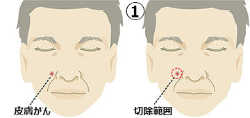 皮膚がん切除の一例