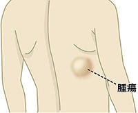 軟部腫瘍（脂肪種など）