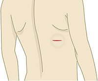 軟部腫瘍（脂肪種など）