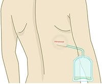 軟部腫瘍（脂肪種など）