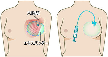 シリコン・インプラントによる再建