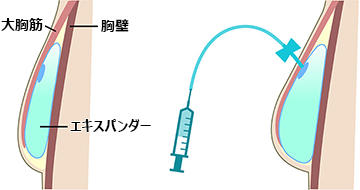 シリコン・インプラントによる再建