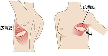 広背筋皮弁による再建