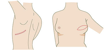 広背筋皮弁による再建