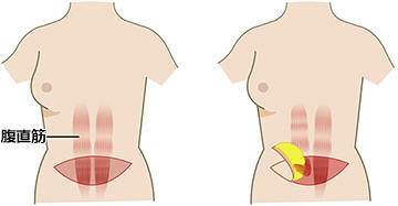 腹直筋皮弁による再建