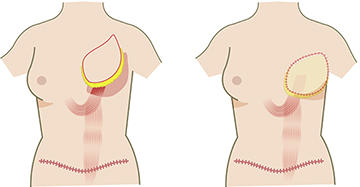 腹直筋皮弁による再建