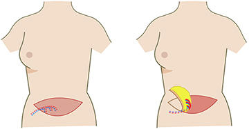 腹直筋皮弁による再建