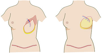 腹直筋皮弁による再建