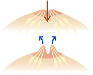 陥没乳頭・乳輪下膿瘍