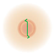 陥没乳頭・乳輪下膿瘍