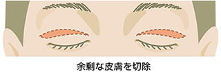 加齢性眼瞼下垂