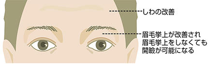 加齢性眼瞼下垂