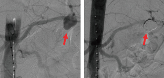 腹部内臓動脈瘤や急性動脈閉塞など