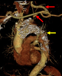 赤印：バイパス黄印：ステントグラフト