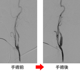 頸動脈狭窄症に対する頸動脈内膜摘除術