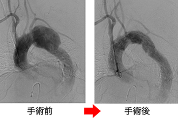 腹部内臓動脈瘤や急性動脈閉塞など