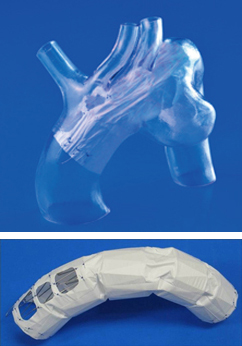 胸部大動脈瘤に対する開窓型ステントグラフト